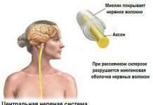 Очі можуть показати розвиток розсіяного склерозу