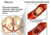 Куріння і високий кровяний тиск може пошкодити Ваш мозок