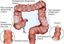 Тест на наявність алкоголю в крові може діагностувати рак товстої кишки
