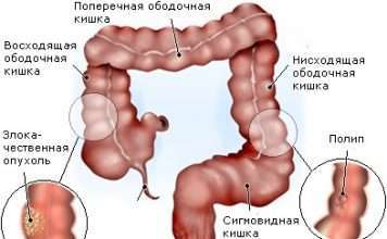 Тест на наявність алкоголю в крові може діагностувати рак товстої кишки